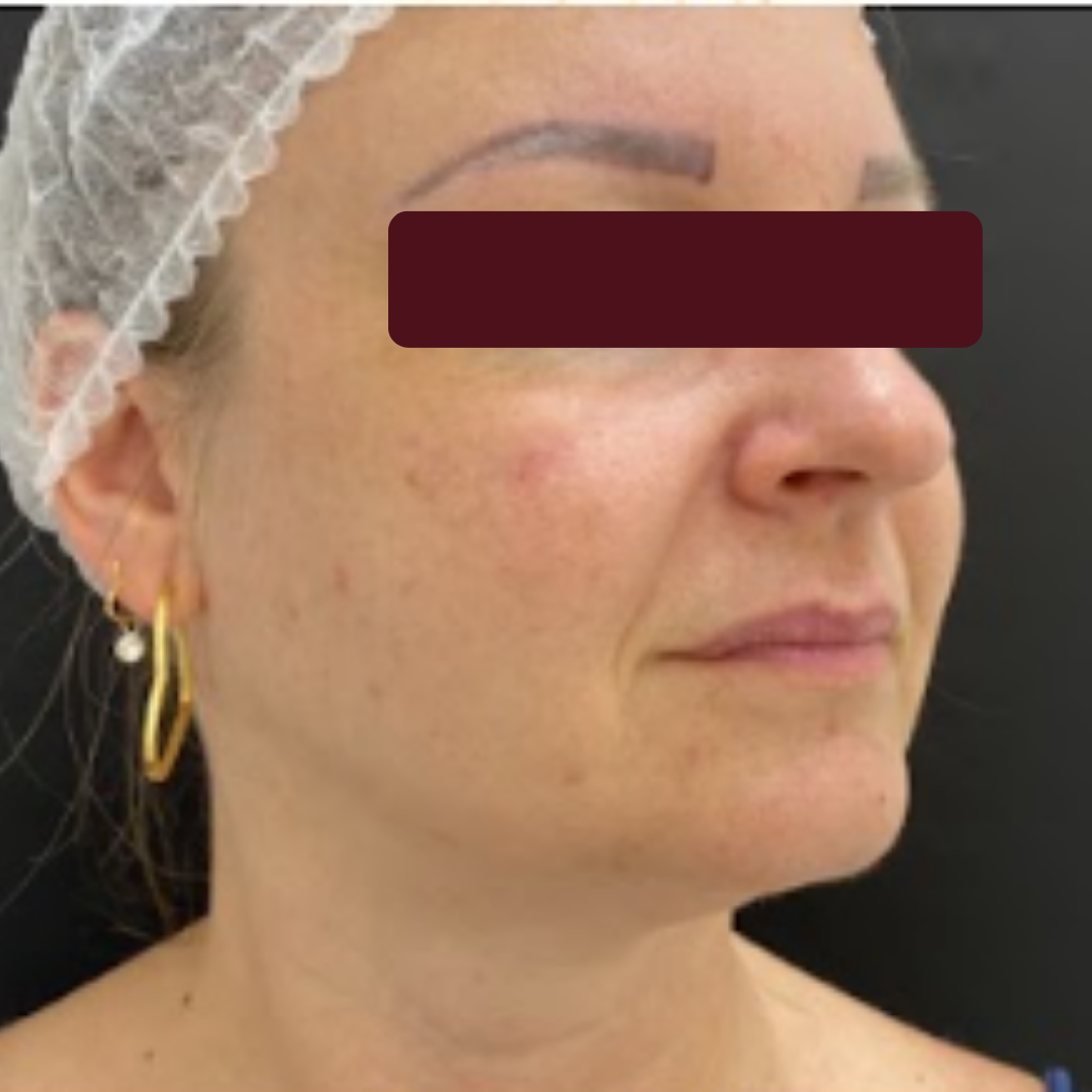 PREENCHIMENTO, depois do tratamento