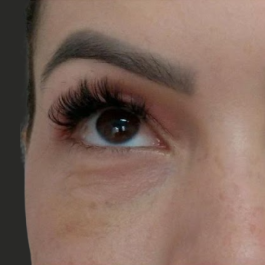 Botox, depois do tratamento