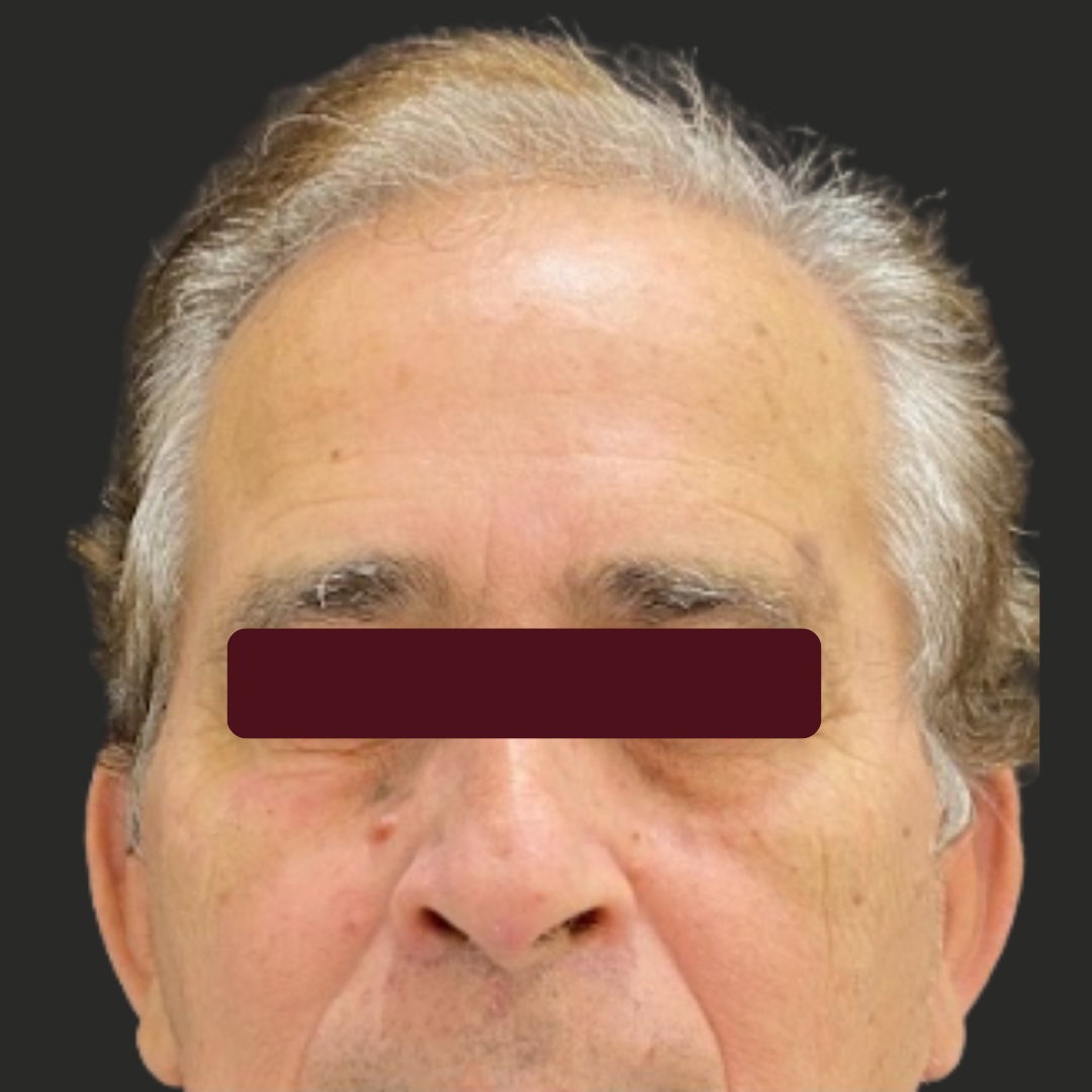 BOTOX, depois do tratamento