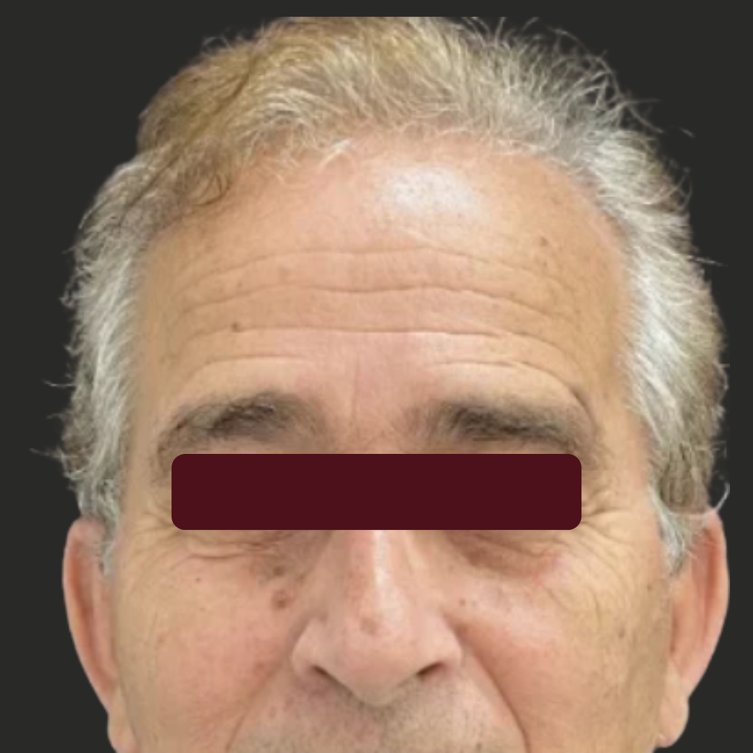 BOTOX, antes do tratamento