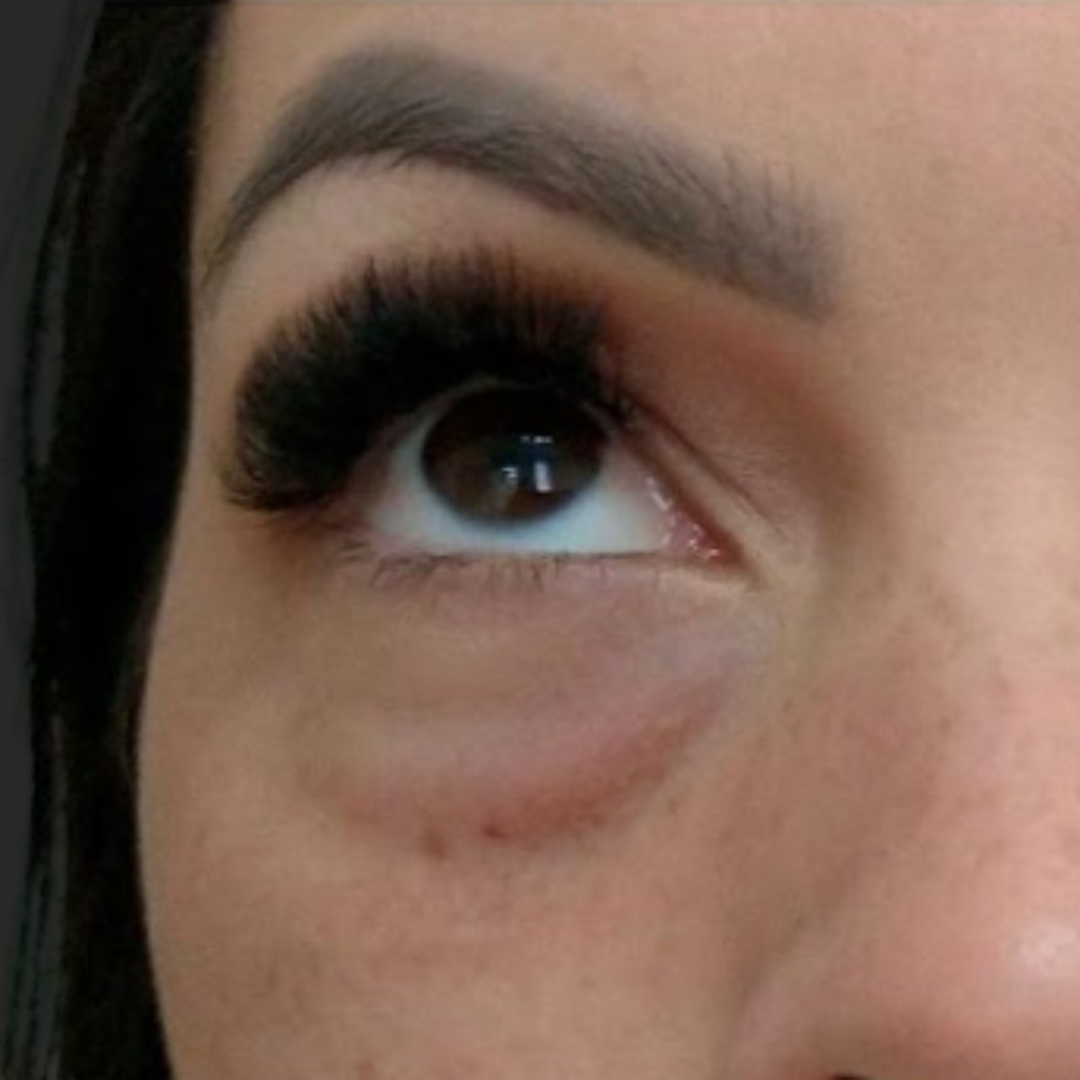Botox, antes do tratamento